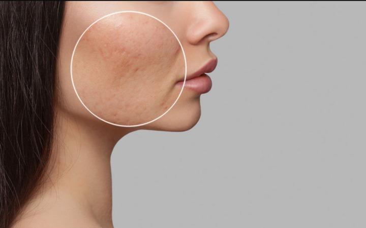 Nguyên nhân gây bít lỗ chân lông-1