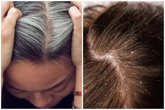 Cách trị gàu cực hiệu quả: Chỉ cần 1 viên aspirin có thể giải quyết vấn đề trong tích tắc