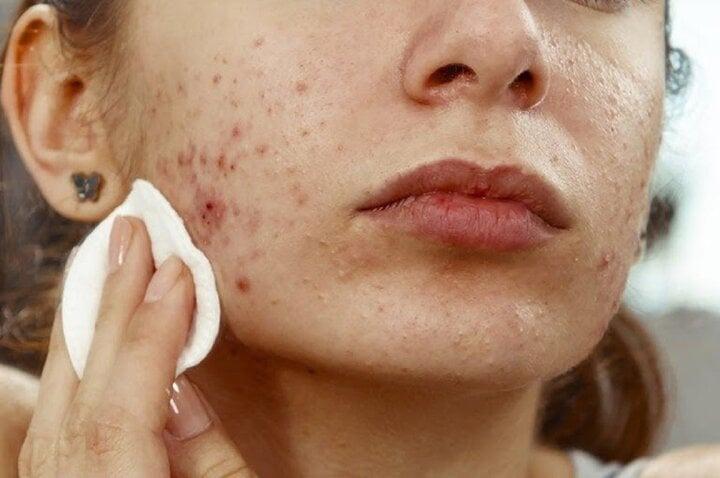 Vì sao mặt tự nhiên nổi nhiều mụn trứng cá?-1