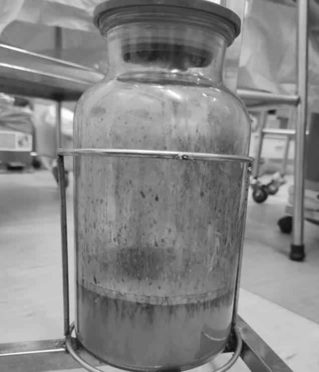 Buồng trứng phình to, nguy kịch vì thói quen phổ biến trong bữa ăn-2