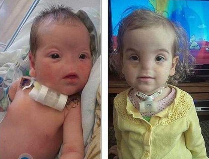 Cuộc sống hiện tại của cô bé không có mũi, phải thở bằng miệng-1