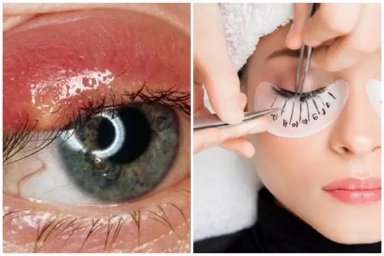 Nối mi nhiều gây hại gì cho mắt?