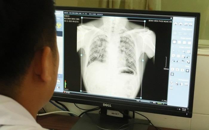 Vụ 6 người tử vong do bụi phổi ở Nghệ An: Phát hiện thêm 57 người mắc bệnh-1