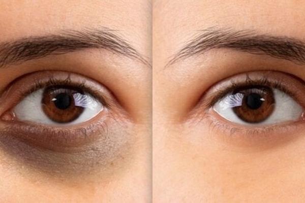 Quầng thâm mắt không chỉ do thiếu ngủ mà còn cảnh báo bệnh nguy hiểm-4