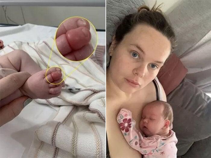 Em bé sơ sinh suýt mất ngón chân chỉ vì sợi tóc của mẹ-1