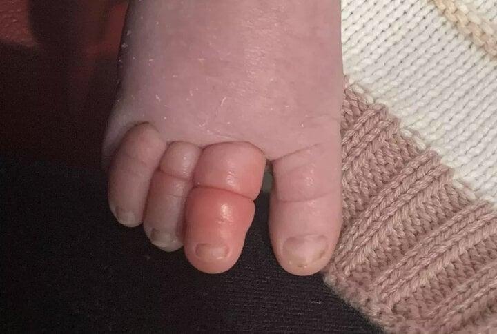 Em bé sơ sinh suýt mất ngón chân chỉ vì sợi tóc của mẹ-2