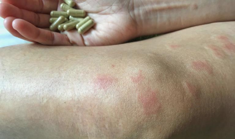 Sự nguy hiểm của căn bệnh nữ minh tinh Châu Hải My phải chịu đựng suốt 20 năm-1