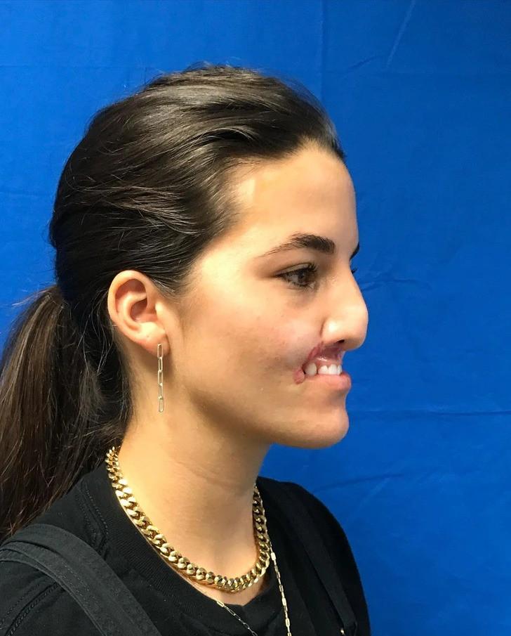 Khởi đầu một hành trình dài của cô gái bị chó Pitbull cắn mất môi trên-2