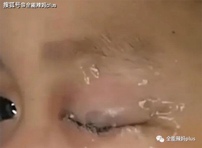 Cậu bé nhỏ keo 502 vào mắt, cách xử lý của người cha được bác sĩ khen ngợi-1