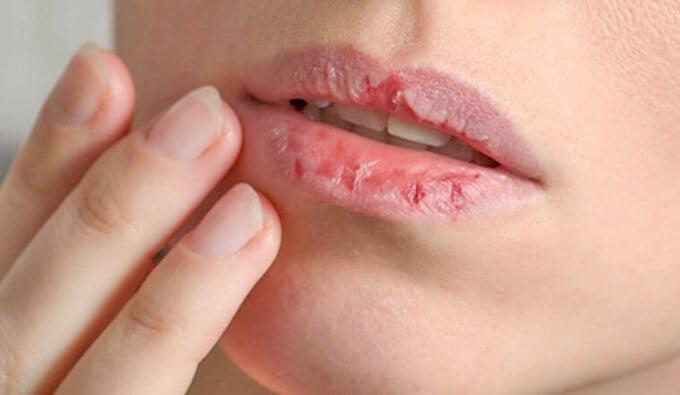 Nhập viện vì thói quen đánh son hàng chục lần mỗi ngày-2