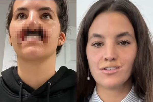 Nữ người mẫu bị chó dữ cắn mất môi trên và hành trình chữa lành gây cảm phục-1