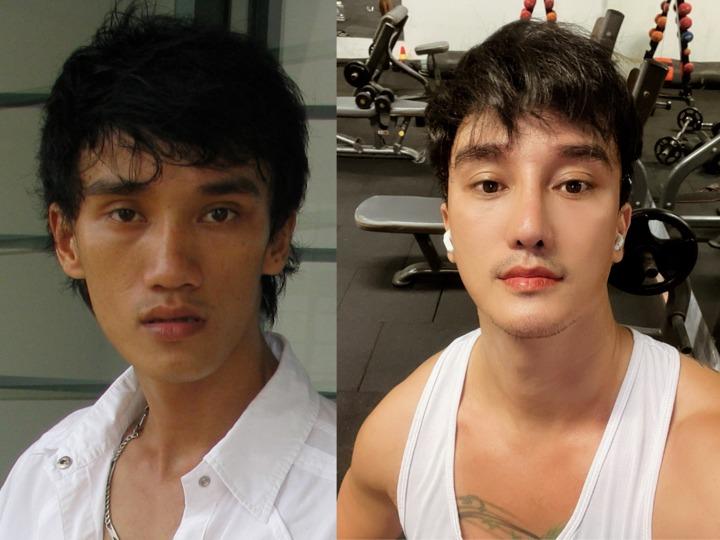 Tâm sự của người đàn ông nghiện phẫu thuật thẩm mỹ-1