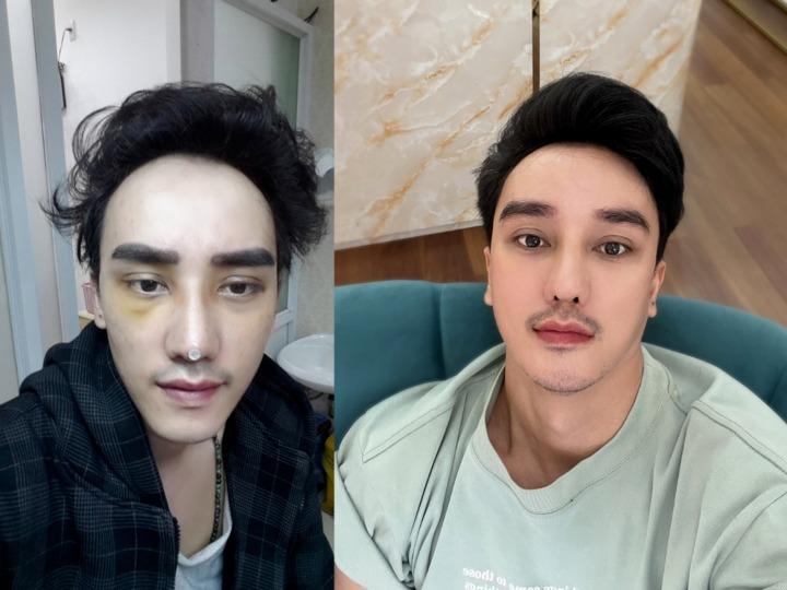 Tâm sự của người đàn ông nghiện phẫu thuật thẩm mỹ-2