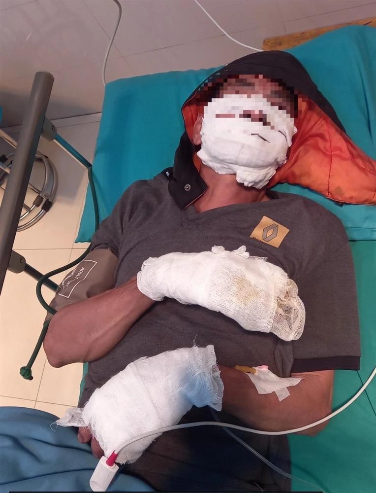 Điện thoại ở đầu giường phát nổ, 2 người bỏng nặng-1