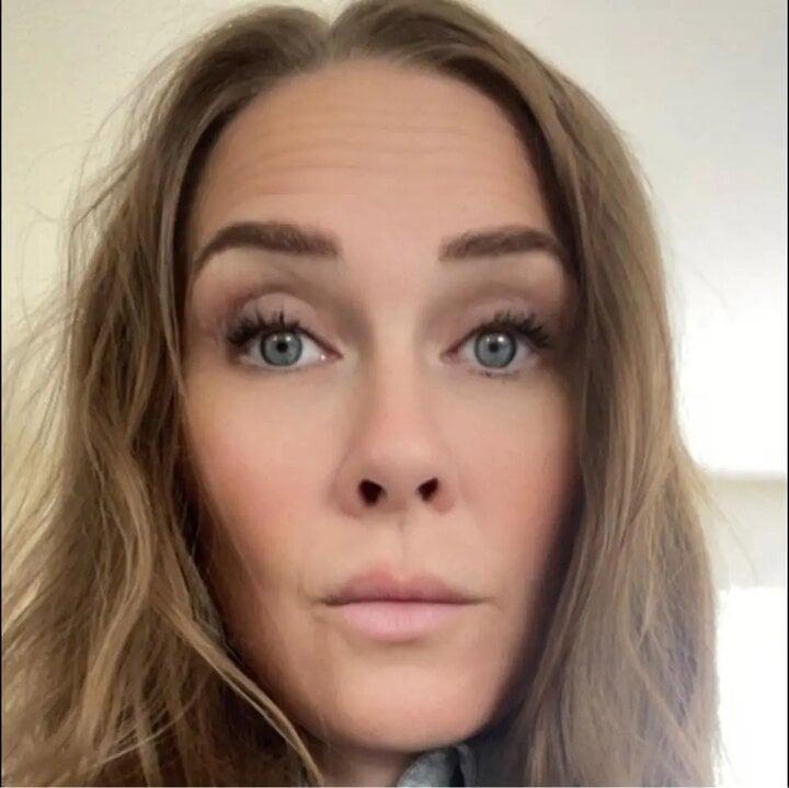 Bác sỹ say rượu khi phẫu thuật thẩm mỹ, bệnh nhân mang sẹo suốt đời-2