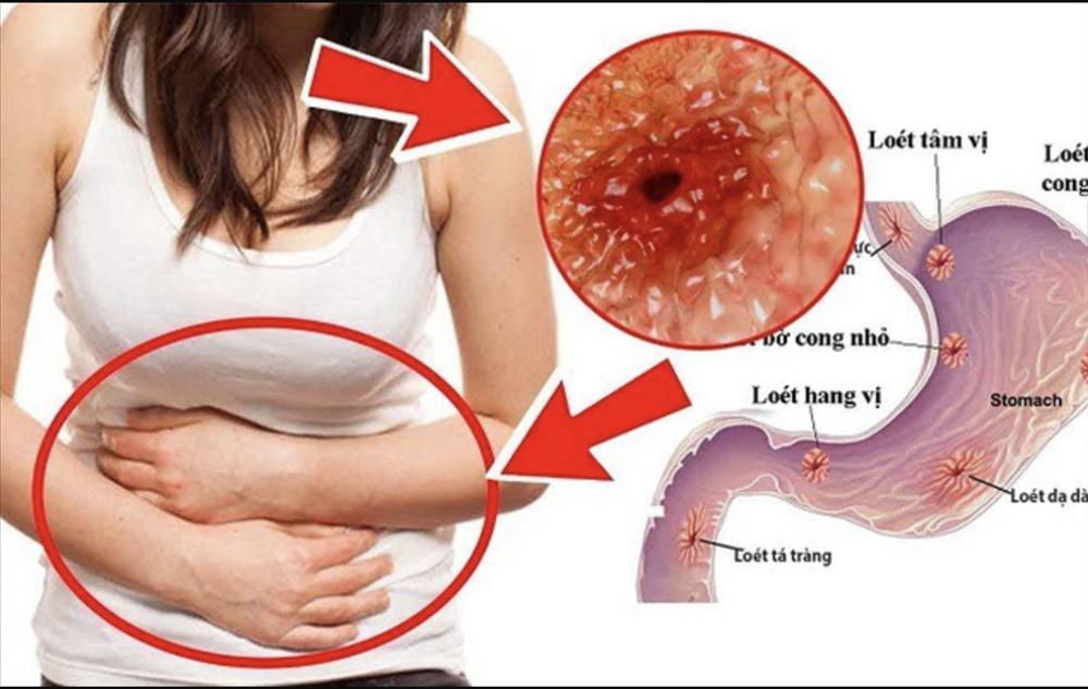 Căn bệnh cướp đi mạng sống của Thanh Sói: 4 dấu hiệu cảnh báo mắc bệnh tuyệt đối không được chủ quan!-3