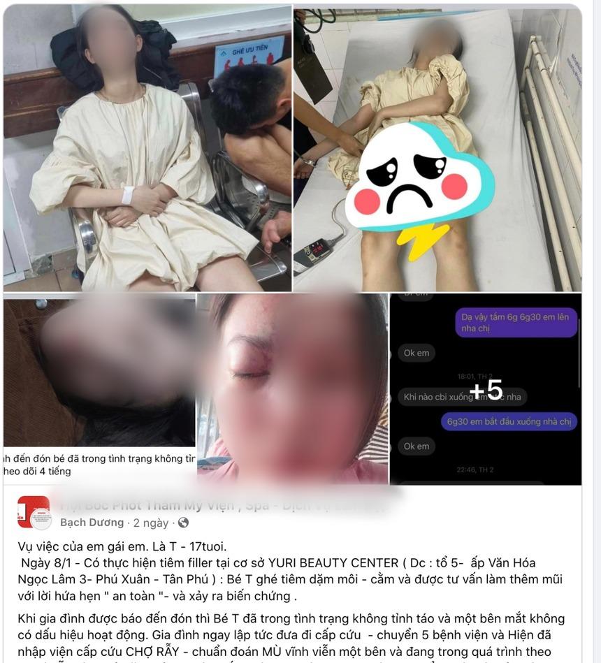 Tiêm filler mũi, cô gái 17 tuổi bị mù mắt-1
