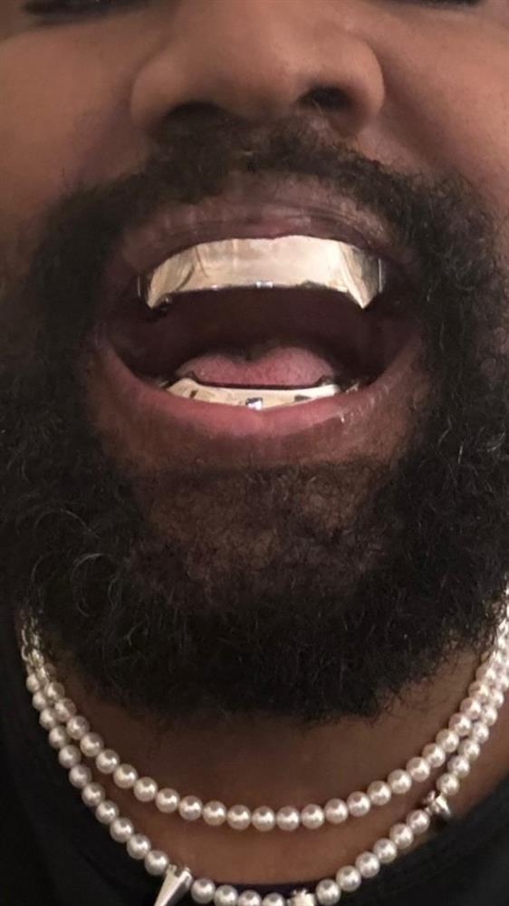 Kanye West gây sốc khi nhổ hết răng thật-1