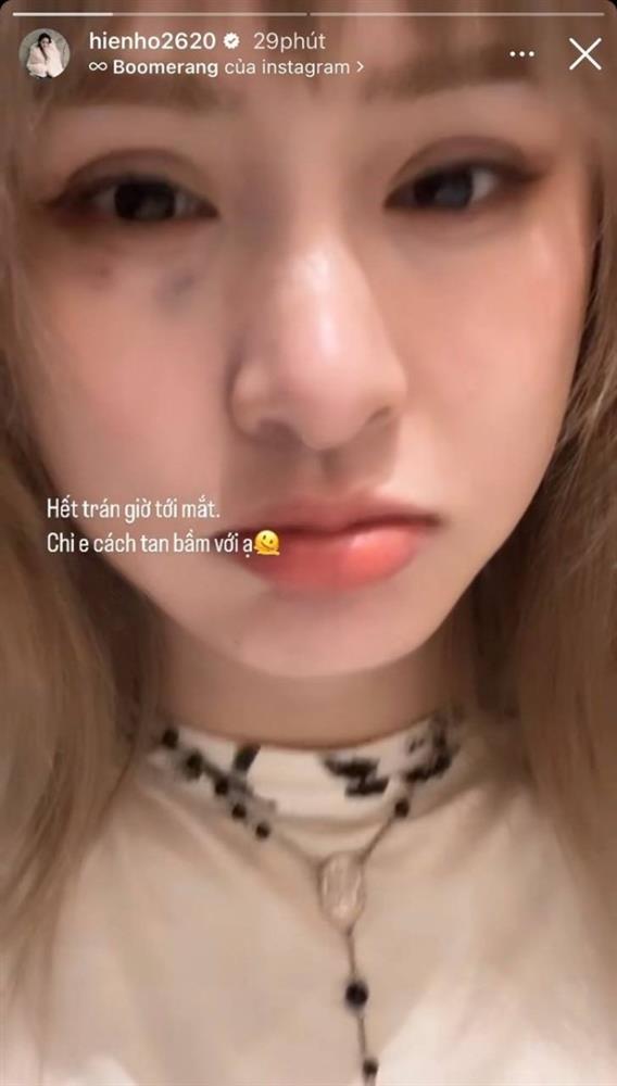 Hiền Hồ xuất hiện với vết bầm lớn trên mặt, nói một câu khiến khán giả thở dài ngao ngán-1