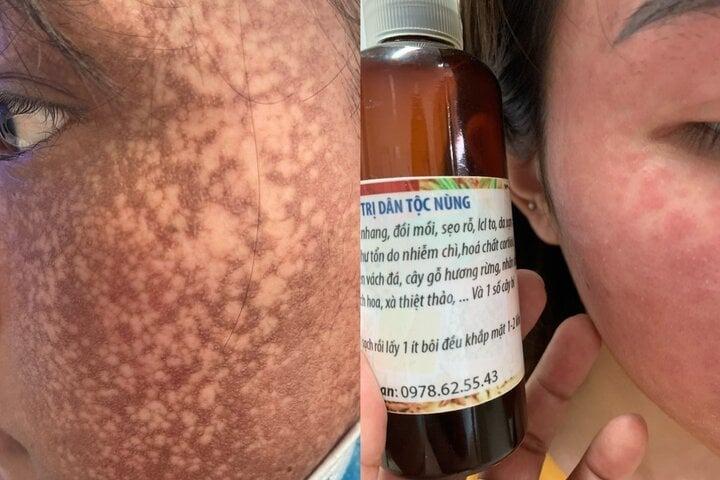 Mua mỹ phẩm trên mạng làm đẹp cấp tốc, nhiều người mất Tết vì biến chứng-1