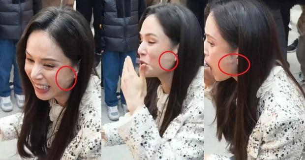 Lý Nhược Đồng dính nghi vấn dao kéo trên khuôn mặt nhưng sự thật lại khiến ai nấy xót xa-1