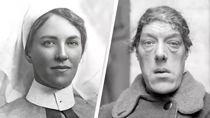 Căn bệnh biến cô gái xinh xắn thành người phụ nữ xấu nhất thế giới-1