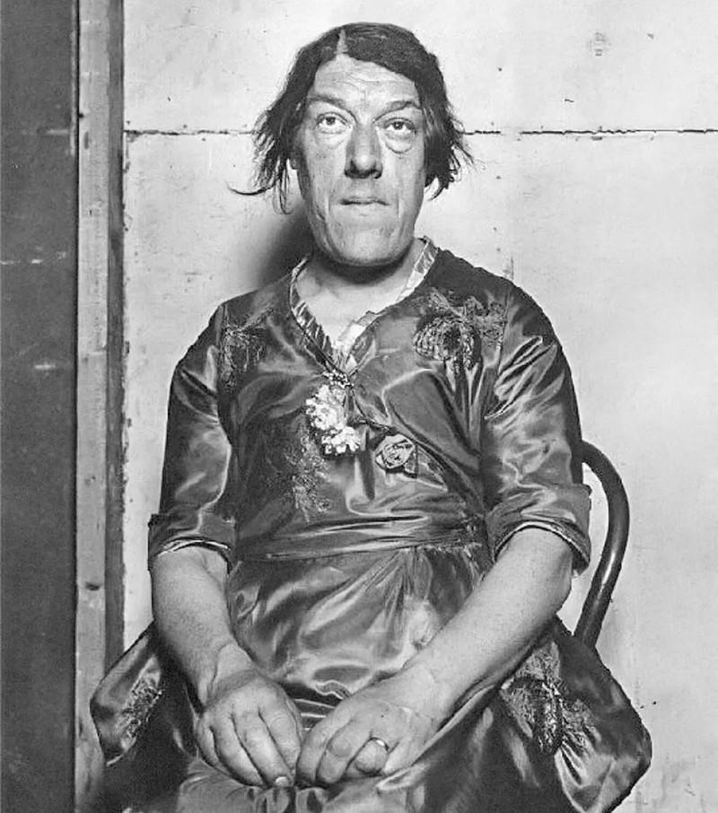 Căn bệnh biến cô gái xinh xắn thành người phụ nữ xấu nhất thế giới-2