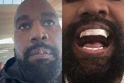 Gương mặt biến dạng của Kanye West sau khi nhổ hết răng