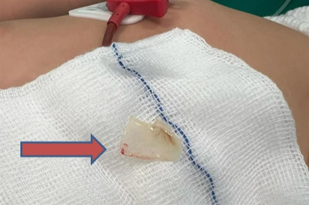 TPHCM: Bé trai 2 tuổi lâm nguy sau khi ăn cháo cá lóc ngày Tết-1