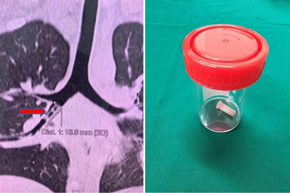 TPHCM: Bé trai 2 tuổi lâm nguy sau khi ăn cháo cá lóc ngày Tết-2