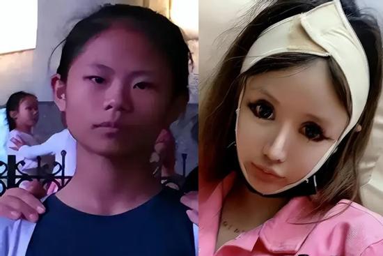 Phẫu thuật 'quá độ', cô gái nghiện làm đẹp từ năm 13 tuổi vô cùng hối hận vì quyết định bản thân