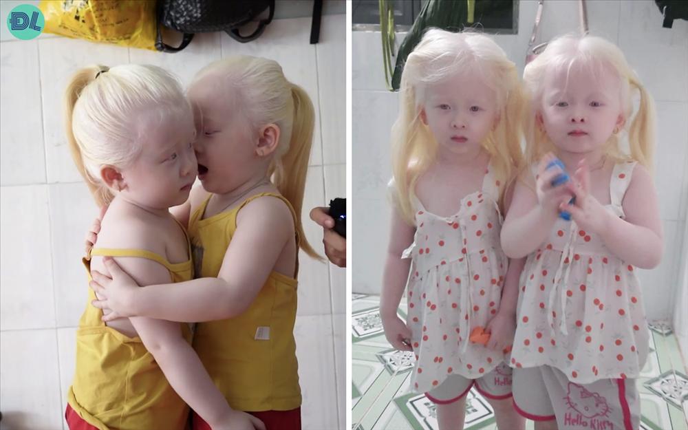 Đẻ cặp song sinh kỳ lạ, vợ chồng Sóc Trăng tuyệt vọng, nhiều năm sau bỗng nổi tiếng khắp vùng: Da trắng, mắt xanh và vô cùng lễ phép, ai gặp cũng yêu mến-2