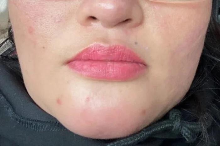 Tiêm filler làm đẹp cằm, người phụ nữ bị chảy mủ trong miệng-1