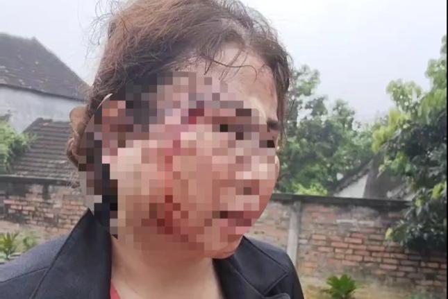 Công an vào cuộc vụ người vợ bị chồng bạo hành nhập viện trước ngày ly hôn-3