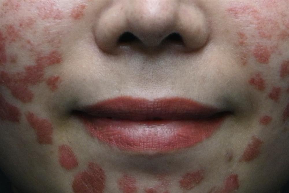 Nỗi đau cô gái biến dạng da nặng: Em không biết họ bắn gì trên mặt-2