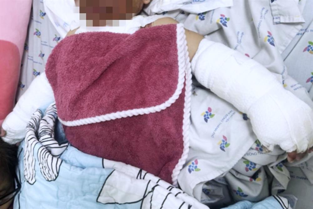 Nổ bình gas mini ở tiệc cưới, bé gái gần 2 tuổi bỏng nặng từ mặt đến chân-1