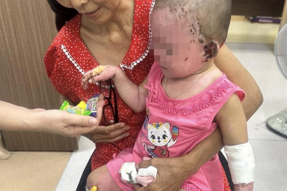 Nổ bình gas mini ở tiệc cưới, bé gái gần 2 tuổi bỏng nặng từ mặt đến chân-2