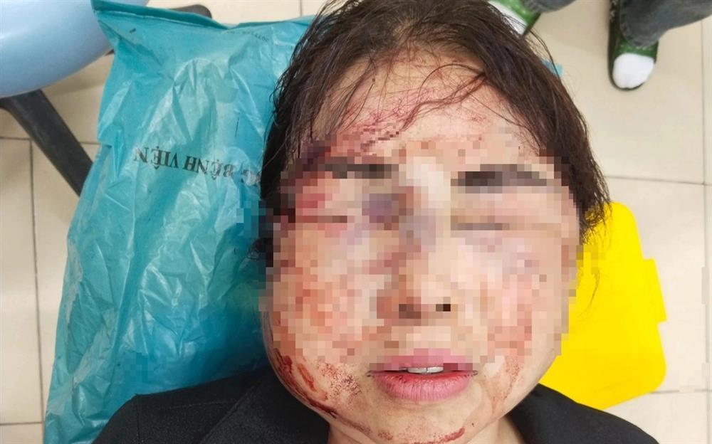 Người phụ nữ bị chồng bạo hành trước ngày ly hôn: Chồng tôi mắc bệnh cuồng ghen-2