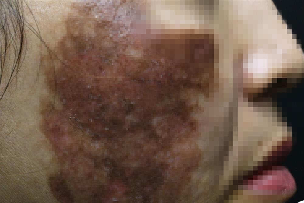 Chị em liều mạng tự lột da làm đẹp: Phá mặt, rỉ dịch nặng vì thuốc rượu-1