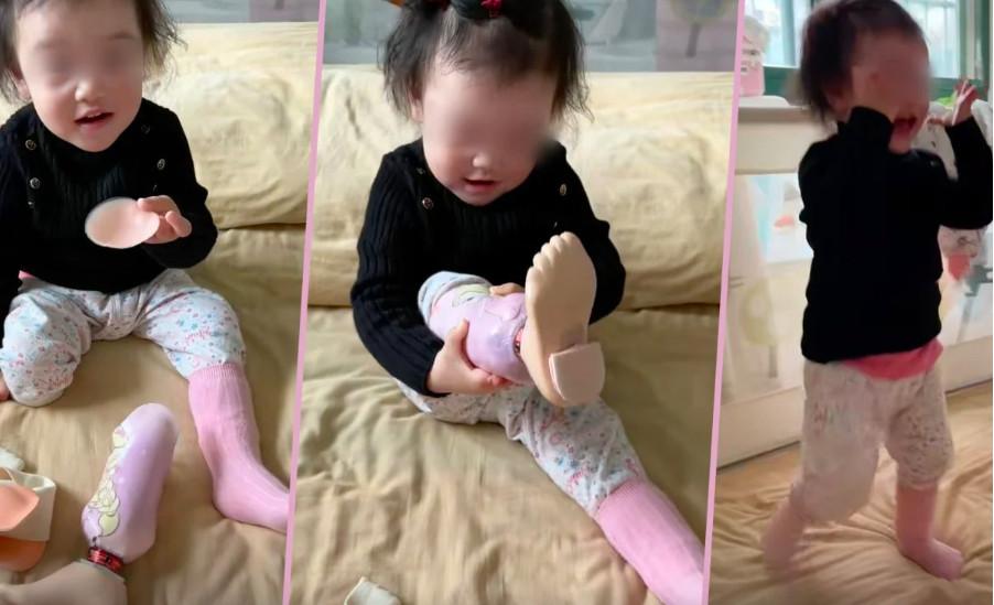 Bé gái 2 tuổi lần đầu tự đeo chân giả khiến hàng chục ngàn người xúc động-1