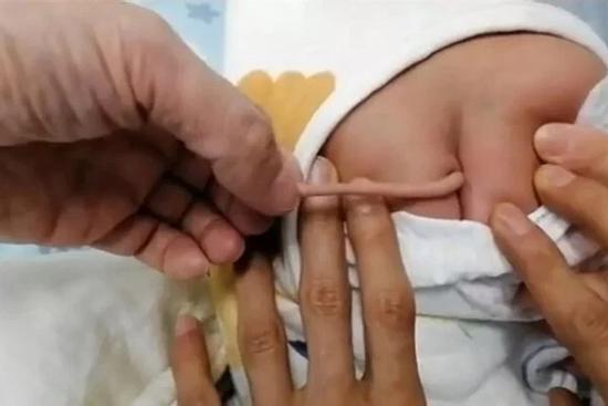 Bé sơ sinh ở Trung Quốc có đuôi dài 10cm mọc ra từ lưng