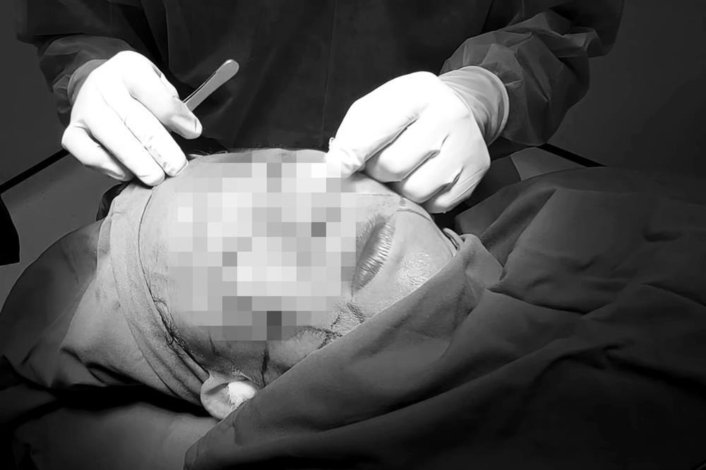 Từ vụ Việt kiều tử vong sau làm đẹp ở mặt: Ai dễ nguy hiểm khi căng da mặt?-1