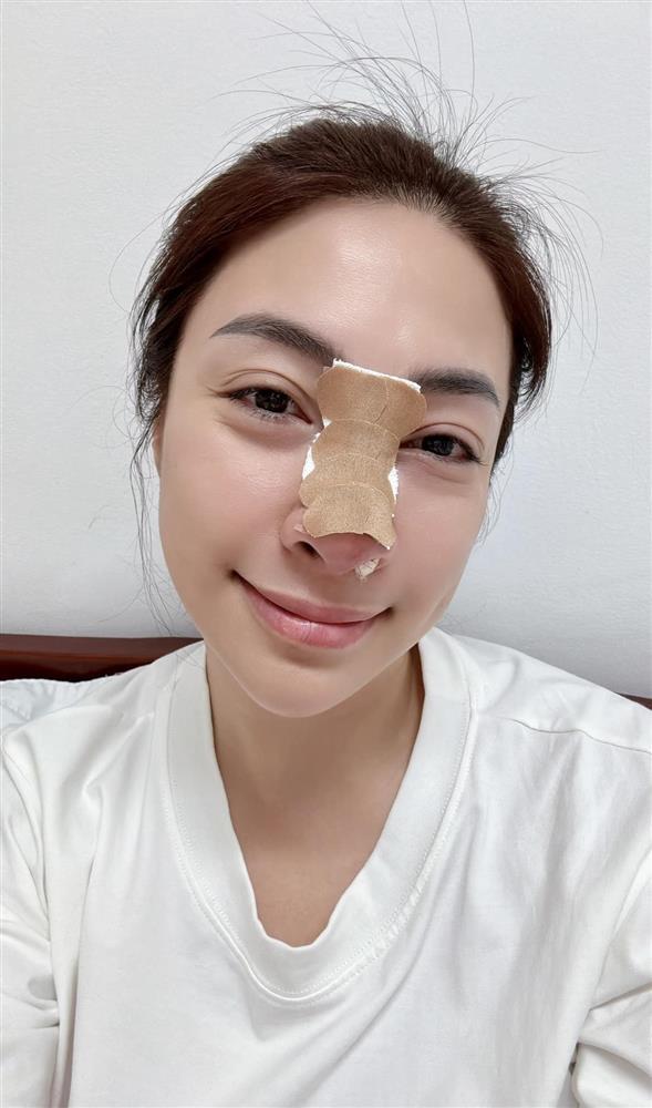 Ca sĩ Pha Lê bị biến chứng nặng sau 12 năm phẫu thuật sửa mũi, chịu cảnh đau tới não khi tháo sụn-2