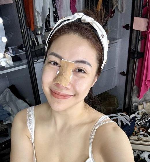 Ca sĩ Pha Lê bị biến chứng nặng sau 12 năm phẫu thuật sửa mũi, chịu cảnh đau tới não khi tháo sụn-3