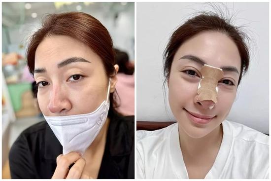 Ca sĩ Pha Lê bị biến chứng nặng sau 12 năm phẫu thuật 'sửa mũi', chịu cảnh 'đau tới não' khi tháo sụn
