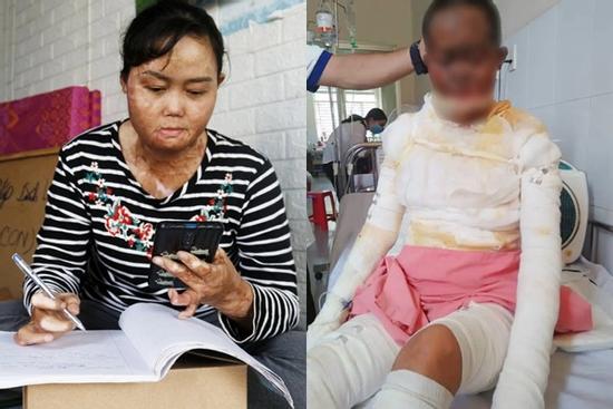 Người phụ nữ bị chồng tưới xăng thiêu sống, bỏng 92% sau 5 năm: Hai người đồng cảnh ngộ nên duyên, cố gắng sống tiếp từng ngày vì 3 con