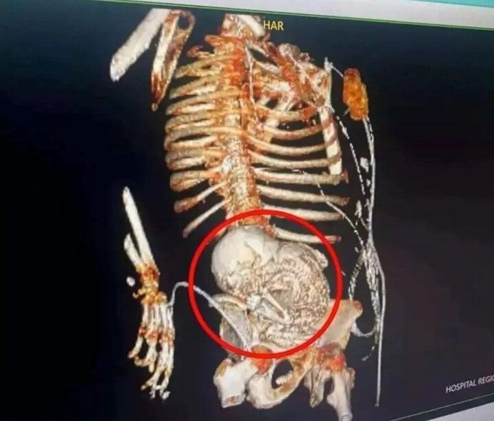 Cụ bà 81 tuổi chết sau khi loại bỏ bào thai bị vôi hóa trong cơ thể suốt 56 năm-2