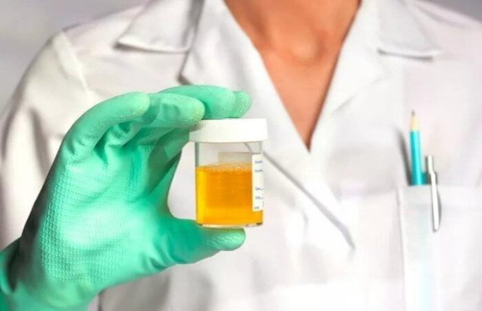 Nước tiểu ra bọt như bọt bia có phải bị bệnh thận?-1