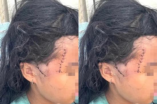 Mẹ và con gái bị người tình chém thương tích nhập viện