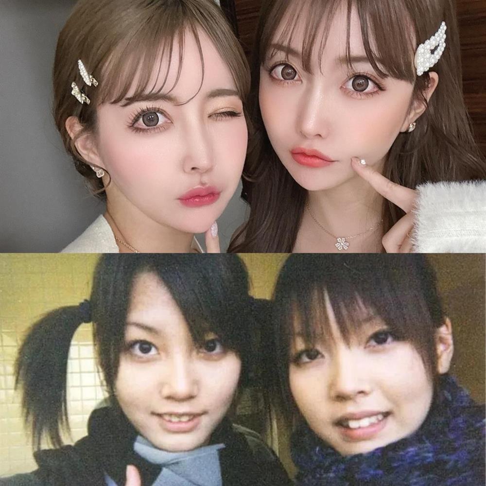 Cặp sinh đôi Nhật Bản gây sốt vì dao kéo toàn bộ gương mặt giờ ra sao?-5